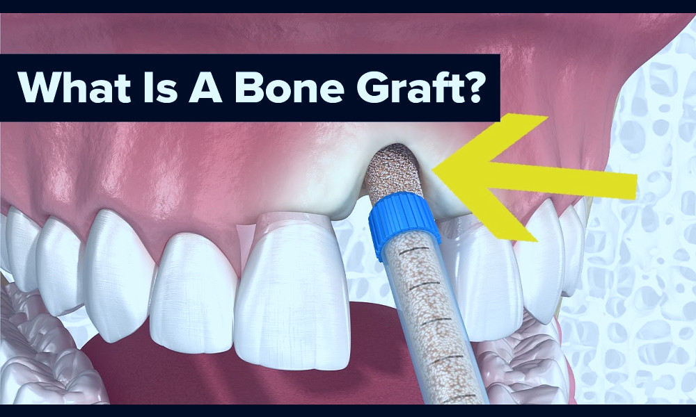 Dental Bone Grafts Explained - YouTube