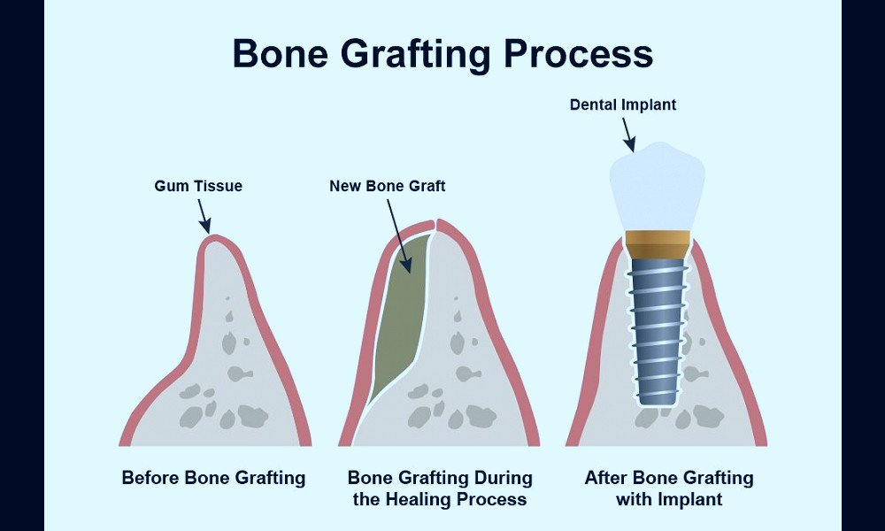 Bone Grafting – Columbia, SC – Elgin, SC – Dr. Robert F. Berger