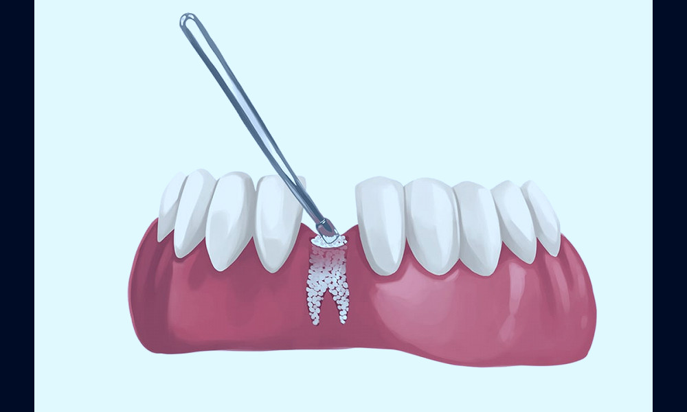 What Are Dental Bone Grafts and Do I Need Them?