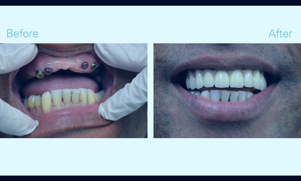 Full Mouth Reconstruction NYC | Information & Pricing