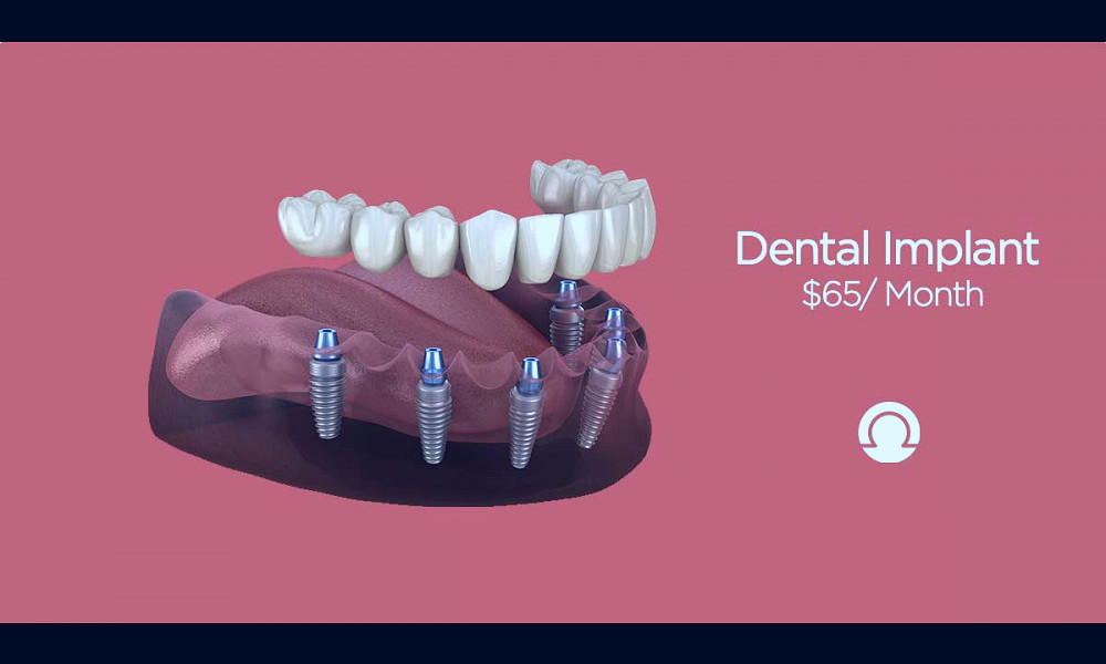 Full Mouth Dental Implants Cost and Procedure