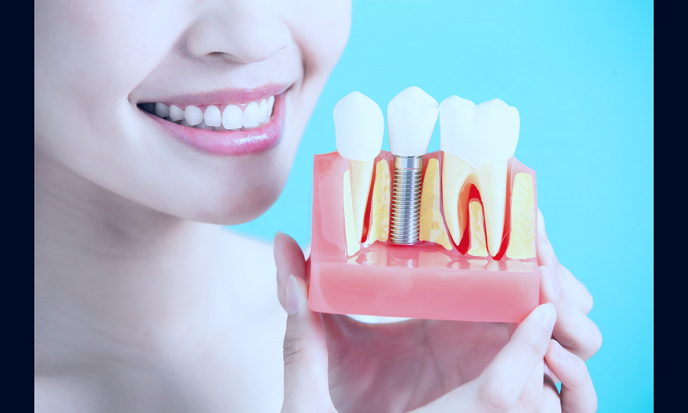 How Much do Dental Implants Cost? | Are You an Implant Candidate?