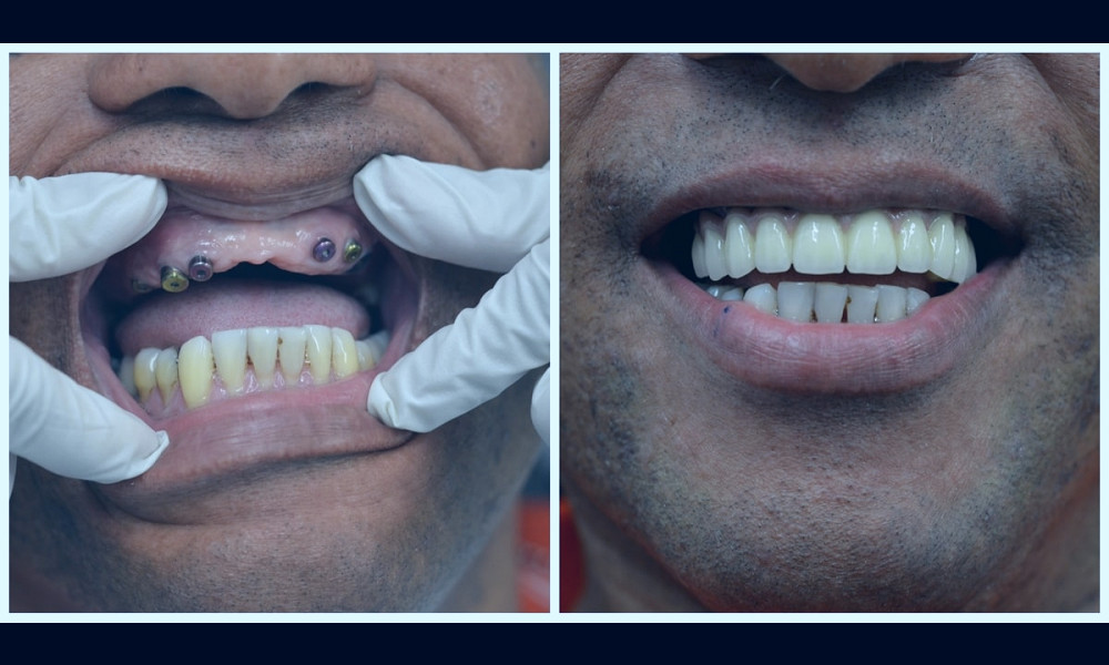 Full Mouth Reconstruction NYC | Information & Pricing