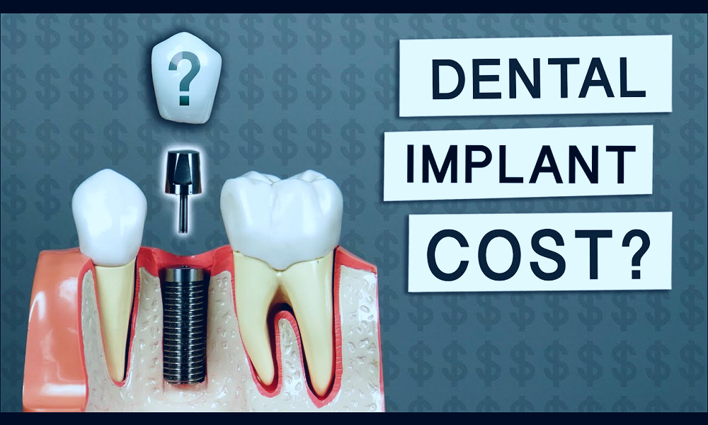 How Much Do Dental Implants Cost? - YouTube