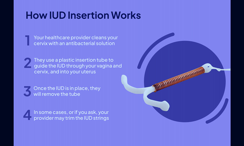 IUD Insertion: How it Works and What to Expect