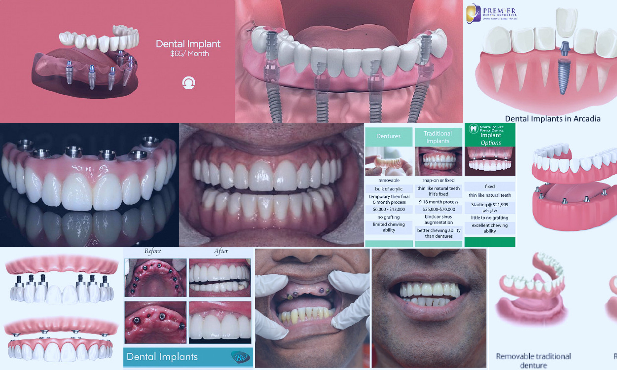 full jaw dental implants cost