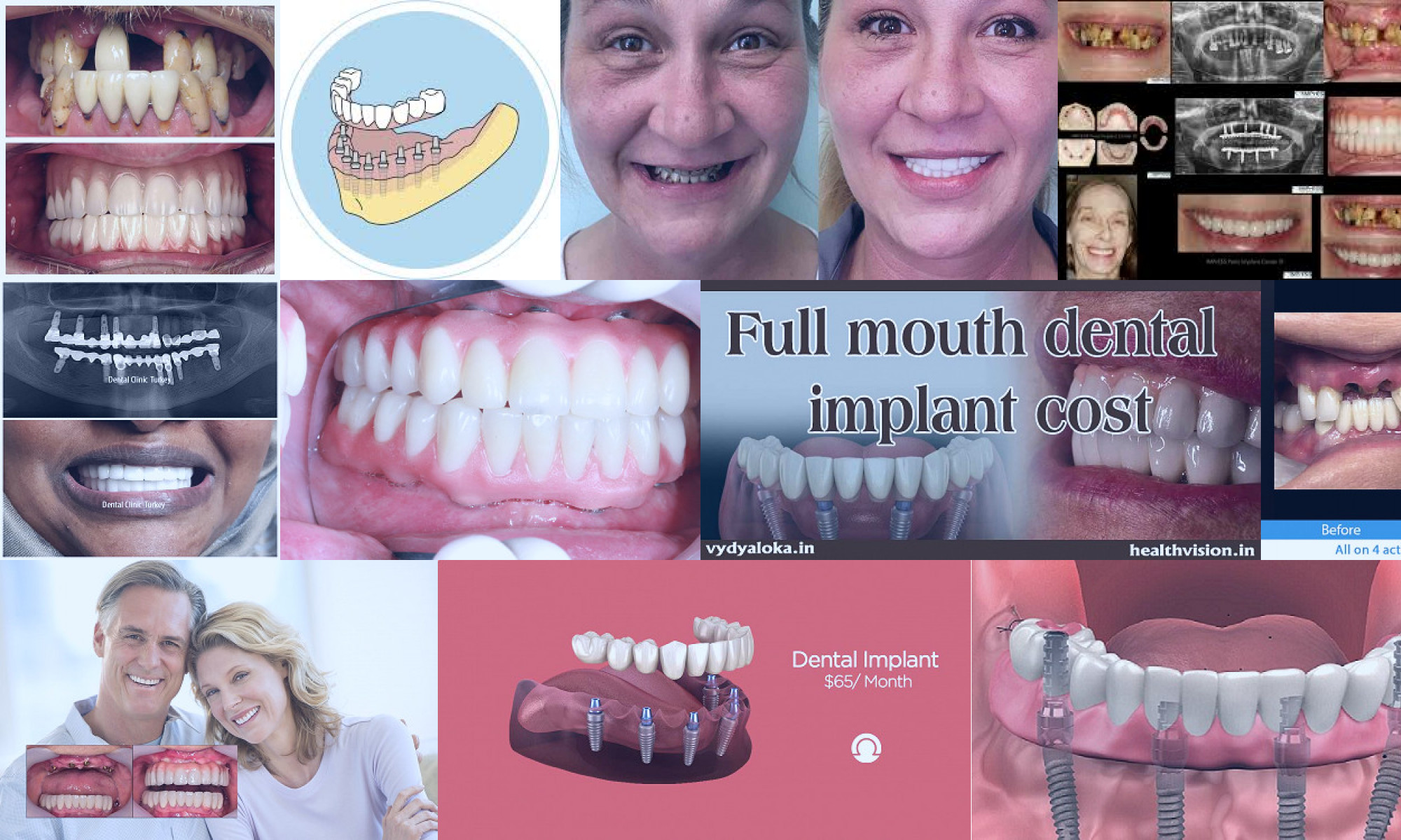 full jaw dental implants cost