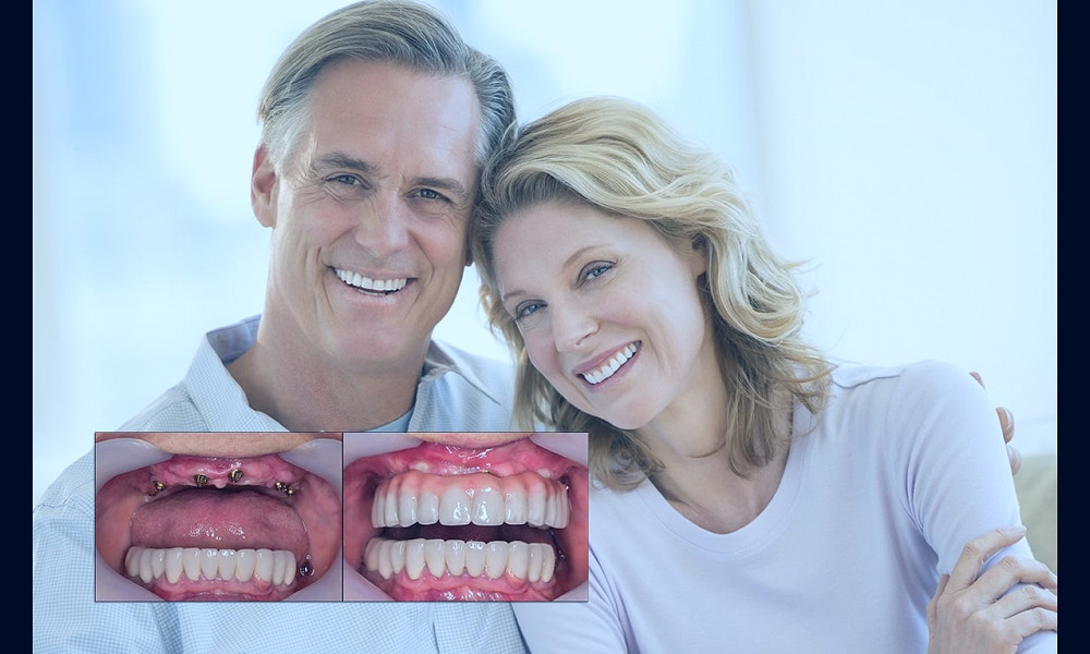 Full Mouth Dental implants Cost and Procedure | Center For Implant Dentistry