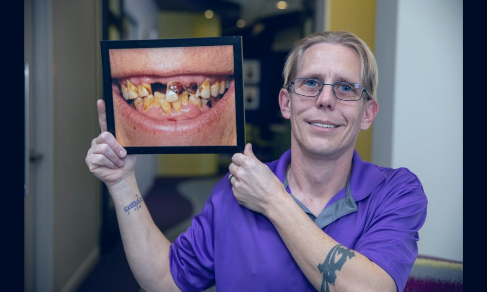 Full Mouth Dental Implants | Dentist | Fort Worth, Texas