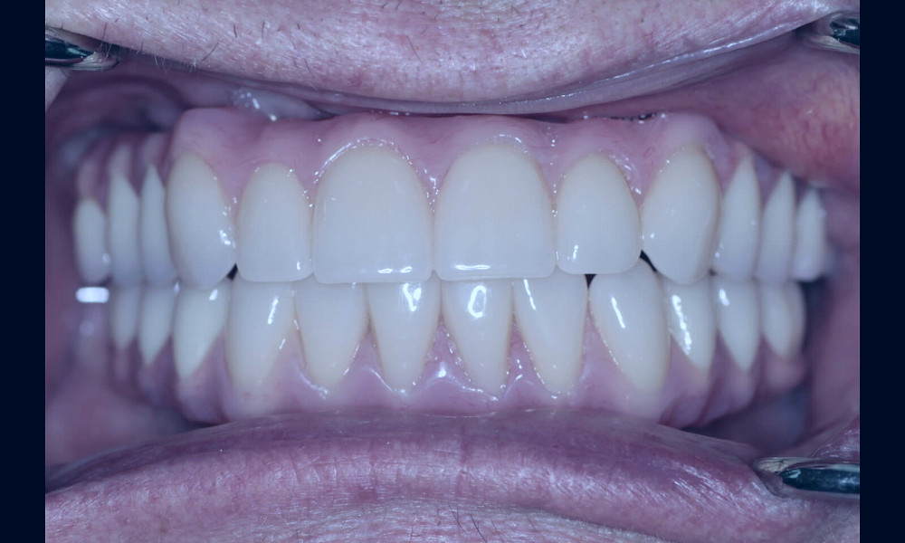 How much is a Full Top Set of Dental Implants?