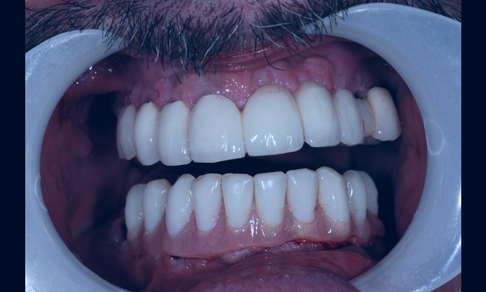 Implant Dentistry | Waltham Dental Implants