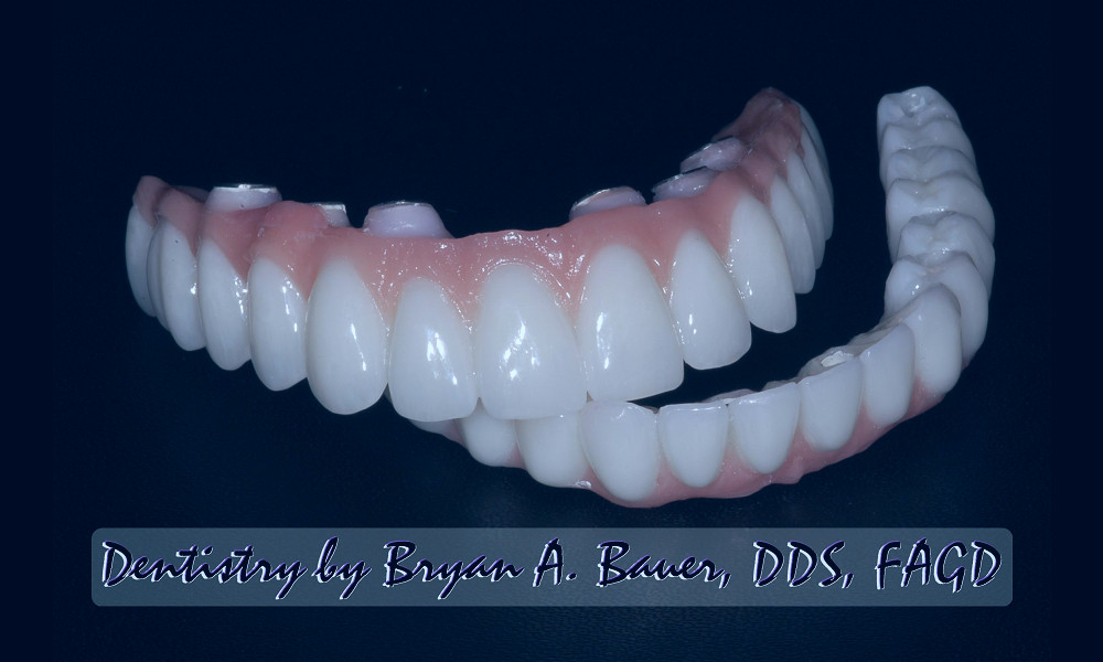 Implant supported dentures - Bauer Smiles