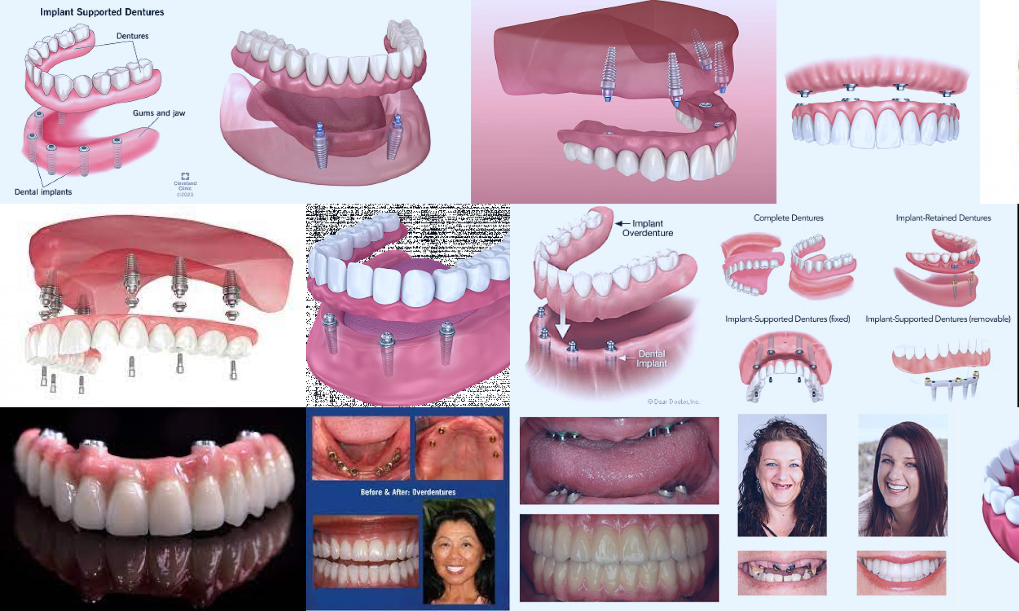 implant supported dentures