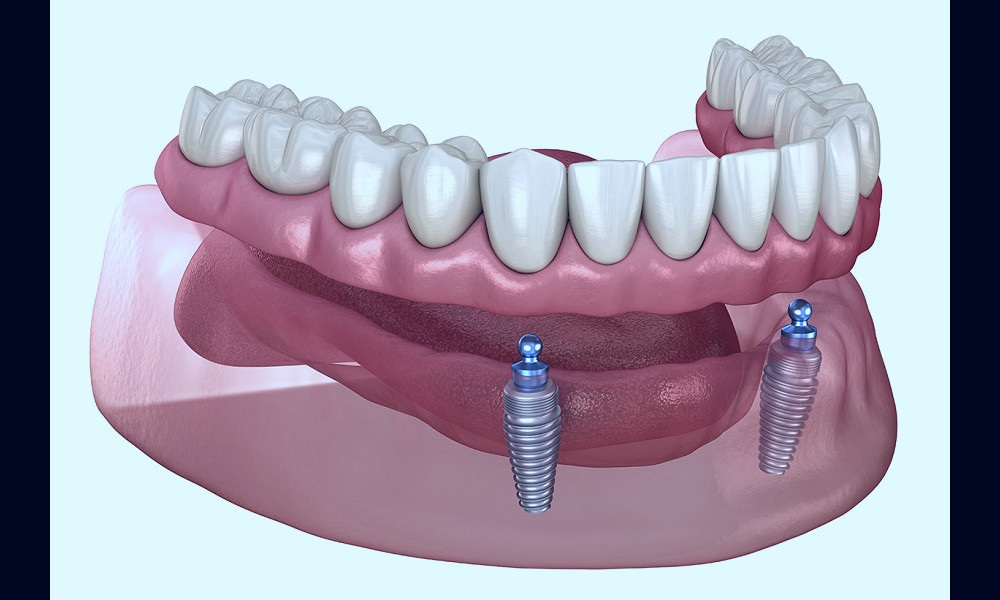 Implant-Supported Overdenture - Keys Dental Specialists