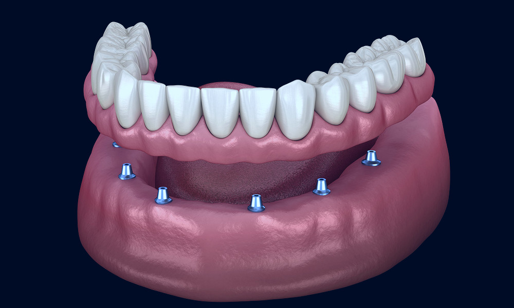 All-On-4 Implant Supported Dentures - Sparacino Periodontics