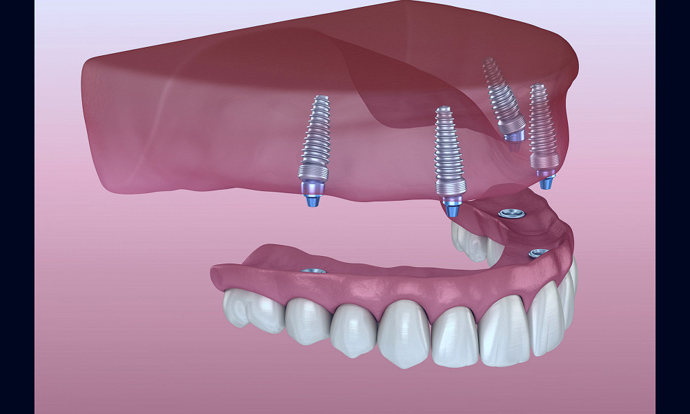 Implant Supported Dentures - Sparacino Periodontics