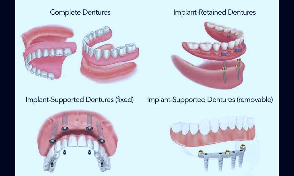 Frequently Asked Questions About Dental Implants and Implant Supported  Dentures