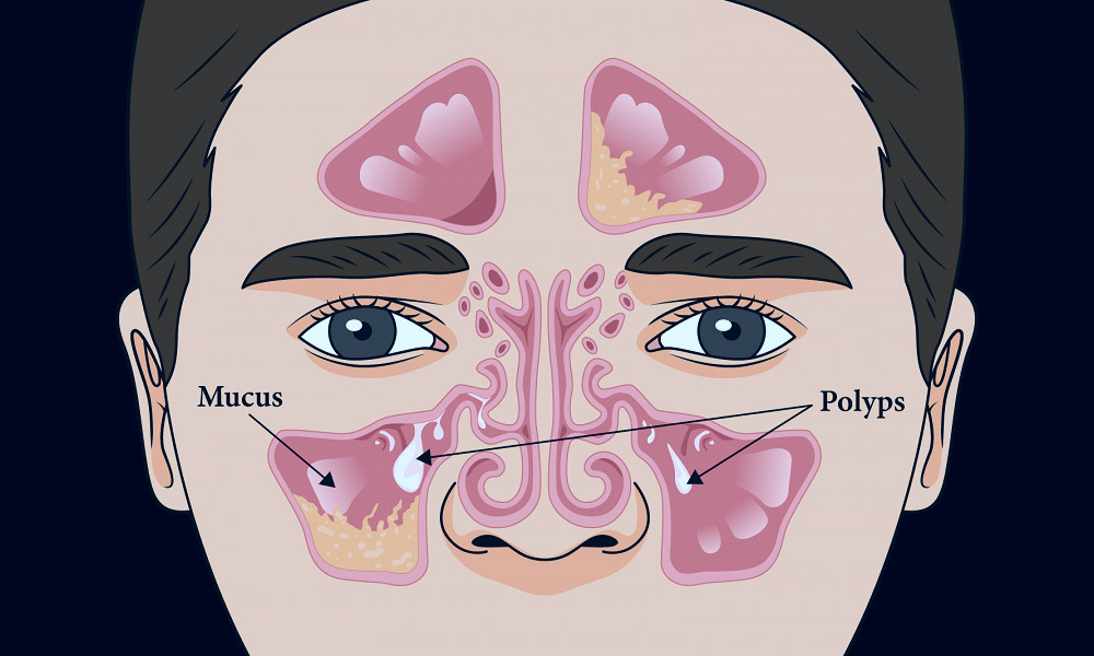 When is a biologic indicated for chronic rhinosinusitis with nasal polyps?  - SinusHealth