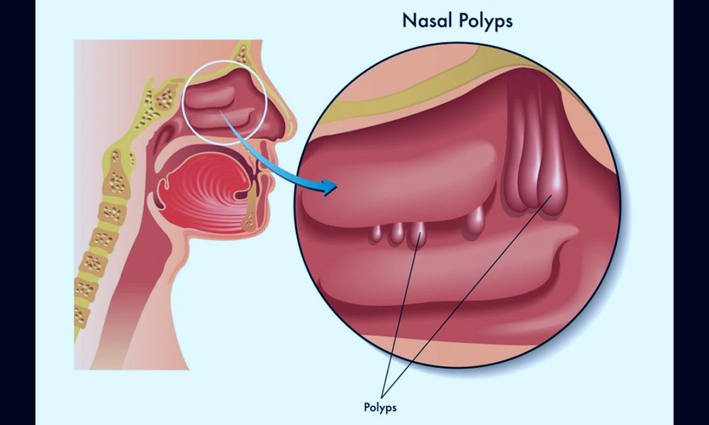 Nasal Polyps - Global Allergy & Airways Patient Platform