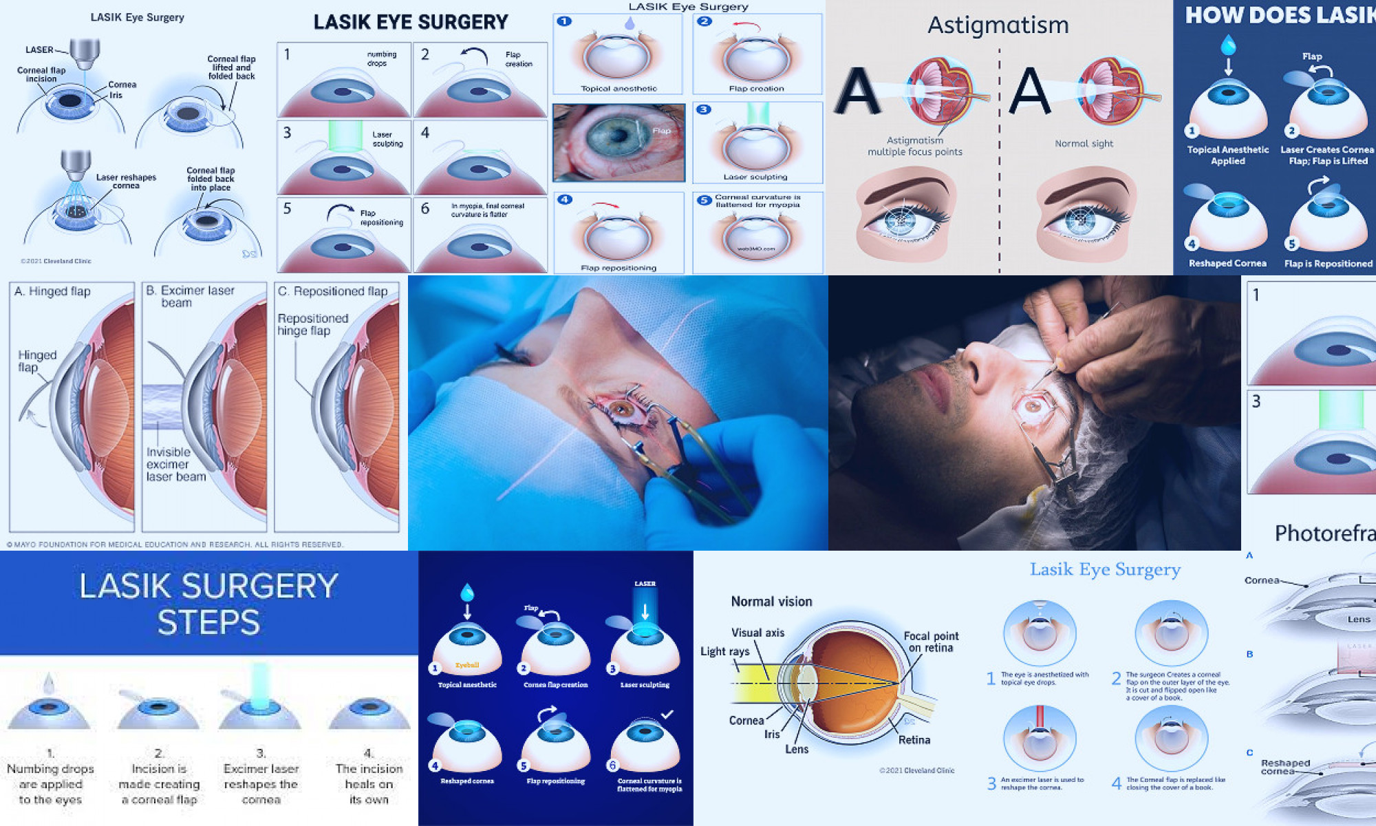 lasik eye surgery