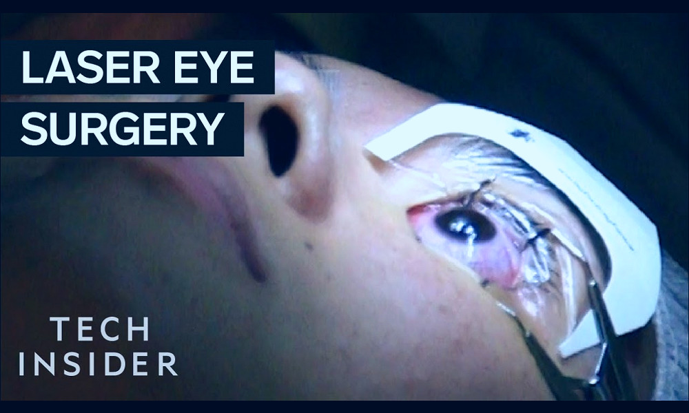 What It's Like To Get Laser Eye Surgery - YouTube