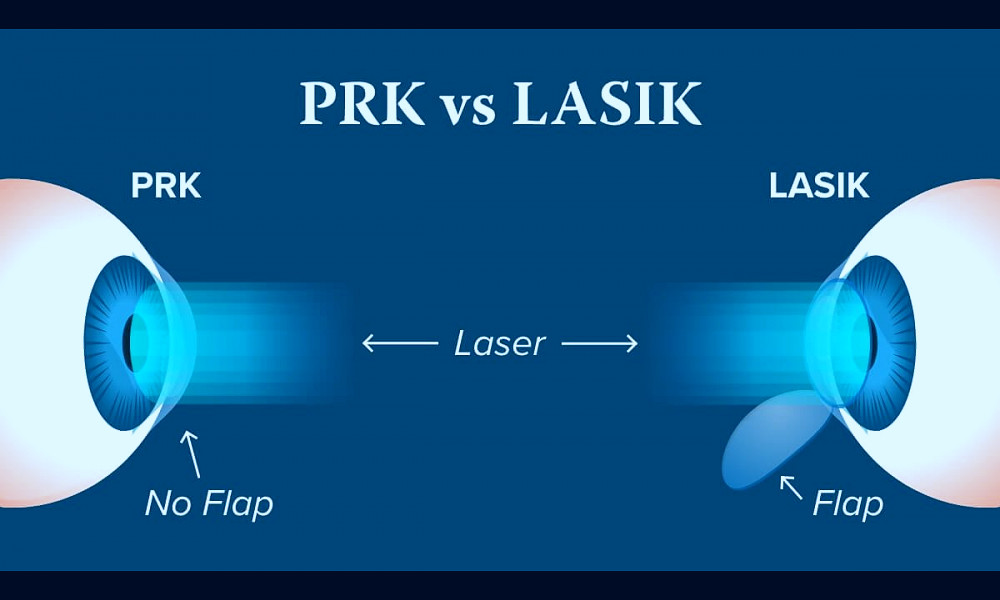 What Is The Difference Between Lasik and PRK Eye Surgery? — iCare Family  Vision