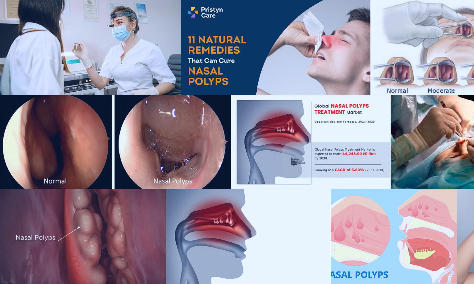 nasal polyps non surgical treatment