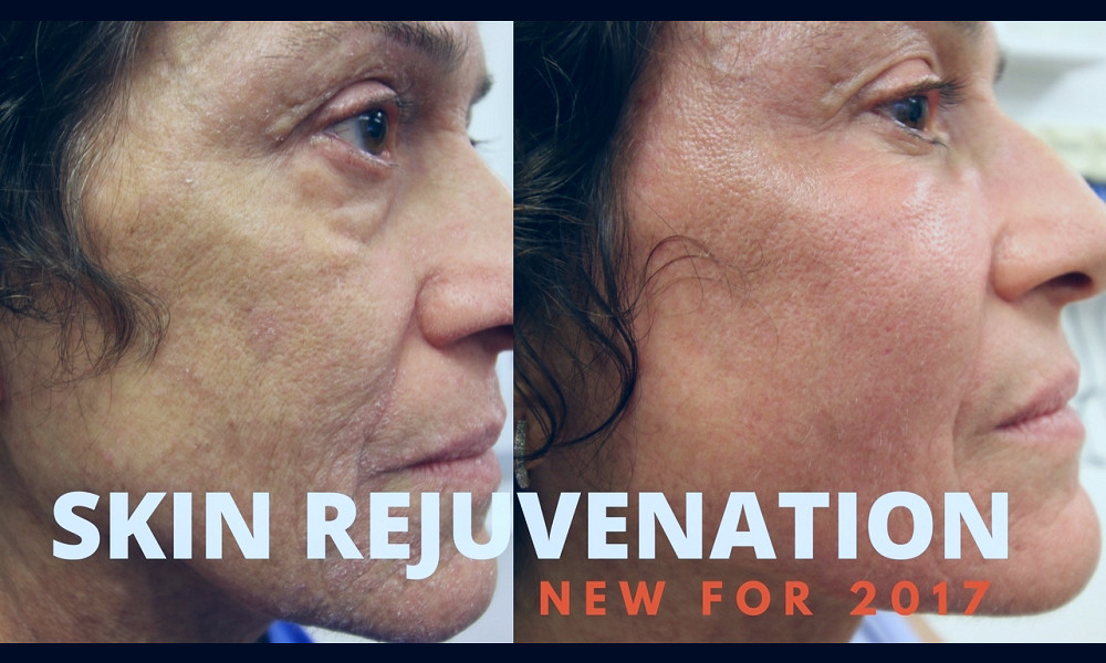 Skin Rejuvenation- Before & Afters - YouTube