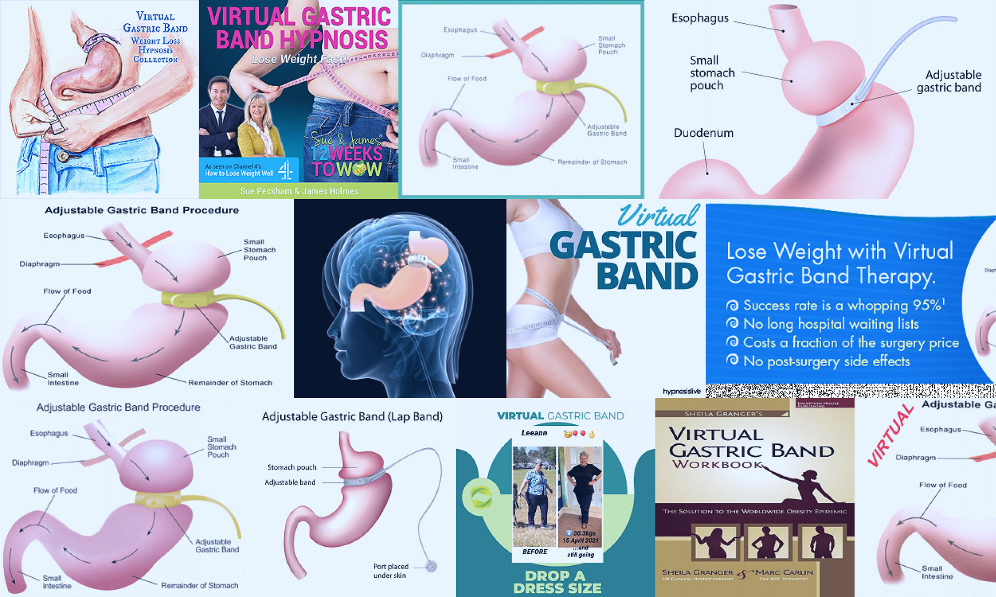 virtual gastric band