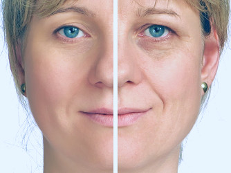 Should I Get Facial Rejuvenation Treatment? | Promd Health