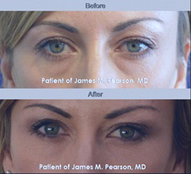 Eye Rejuvenation Photos - Before & After - Dr. James Pearson Facial Plastic  Surgery
