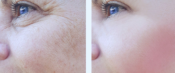 9 Skin Rejuvenation Treatments That Can Make You Look Younger – SkinKraft