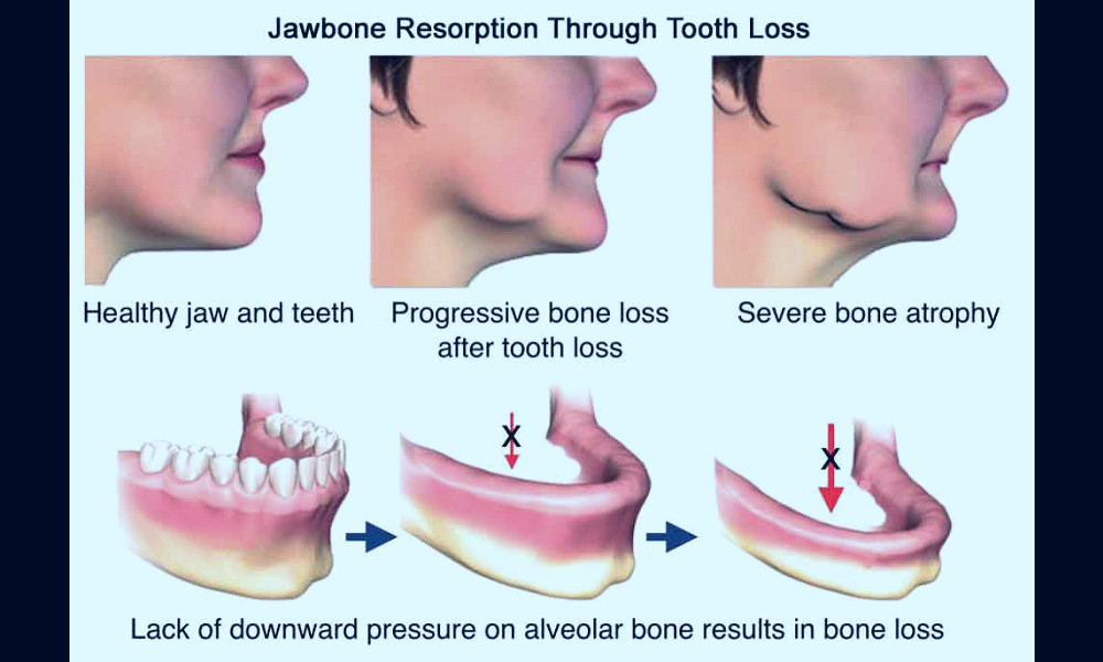 What Is A Bone Graft And Why Do I Need It? | Scottsdale Dental Solutions