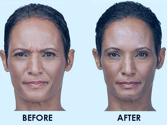 Botox: Anti-Aging Artistry In Stamford CT