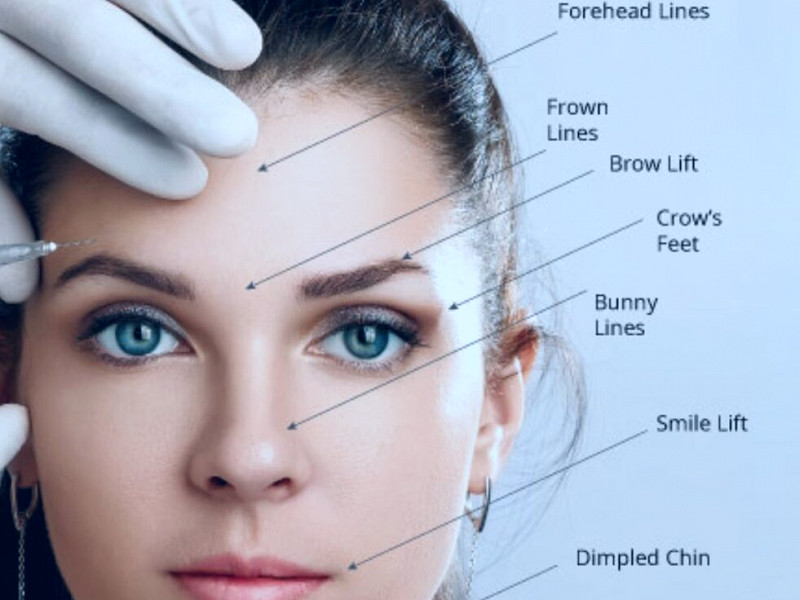 Botox For Younger Skin - Clinique Dallas