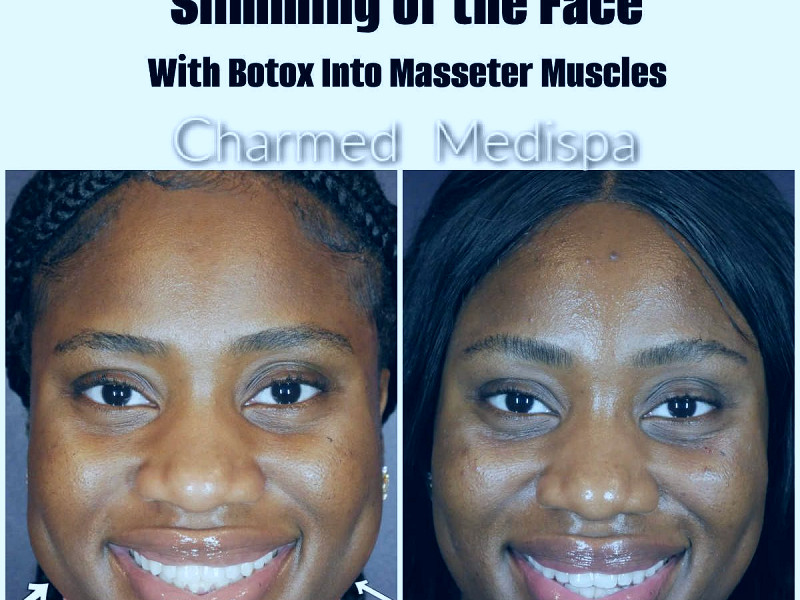 Achieve A Defined Jawline and Relieve Tension and Clenching of Teeth with  Masseter Botox in Delaware – Charmed Medispa