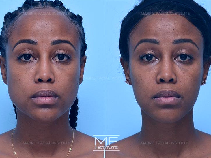 BOTOX® for Masseter & Jaw Before & After Photo Gallery | San Francisco, CA  | Mabrie Facial Cosmetic, Inc: David C. Mabrie, MD FACS