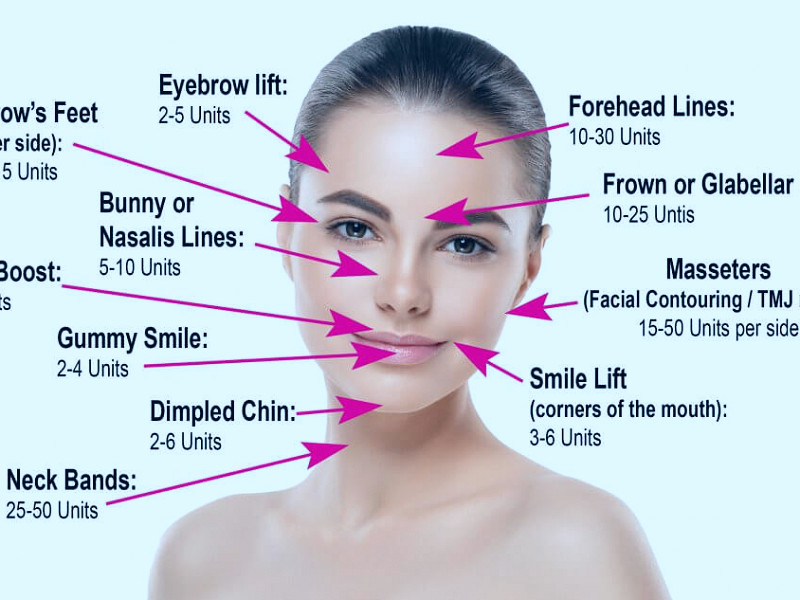 Botox Injection Sites: What Facial Areas Can Be Treated With Botox?