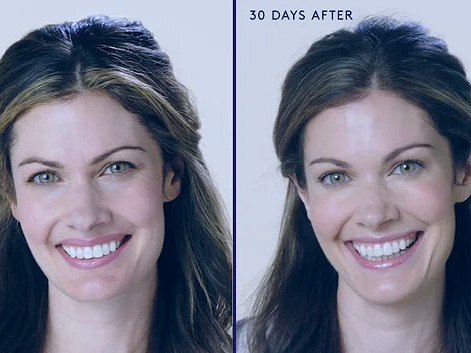 Before & After | BOTOX® Cosmetic