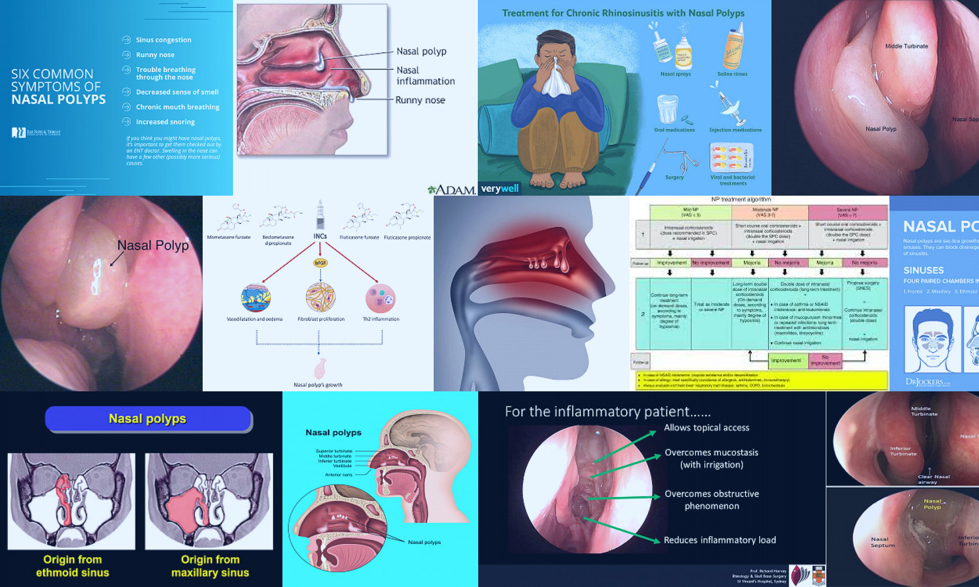 inflammation medication nasal polyps type