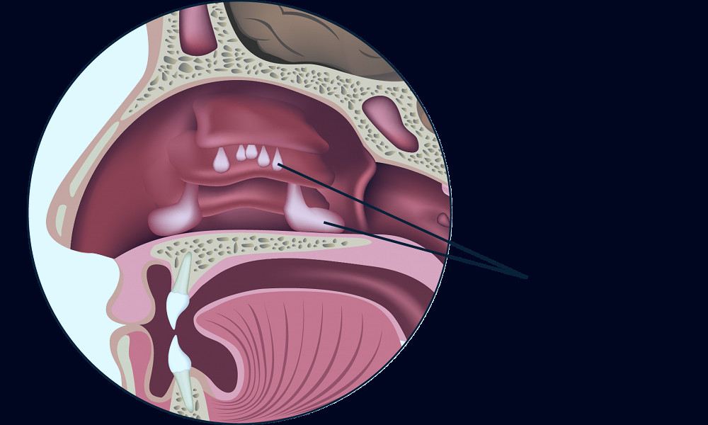 ENT Doctor in Boise, Meridian Treating Nasal Polyps | Treasure Valley Nasal  and Sinus Center