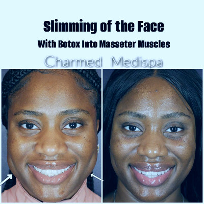 Achieve A Defined Jawline and Relieve Tension and Clenching of Teeth with  Masseter Botox in Delaware – Charmed Medispa